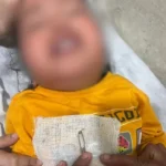 श्रीनगर गढ़वाल में हैरान करने वाला मामला, डेढ़ साल की बच्ची के नाक से निकली सेफ्टी पिन A shocking incident took place in Srinagar, Garhwal. A safety pin was found in the nose of a one-and-a-half-year-old girl.