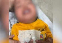 श्रीनगर गढ़वाल में हैरान करने वाला मामला, डेढ़ साल की बच्ची के नाक से निकली सेफ्टी पिन A shocking incident took place in Srinagar, Garhwal. A safety pin was found in the nose of a one-and-a-half-year-old girl.