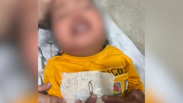 A shocking incident took place in Srinagar, Garhwal. A safety pin was found in the nose of a one-and-a-half-year-old girl. A shocking incident took place in Srinagar, Garhwal. A safety pin was found in the nose of a one-and-a-half-year-old girl.
